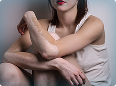 womane-with-vitiligo