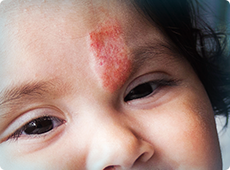 child-with-face-birthmark-ben-001