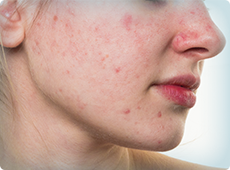 girl-with-acne-ben-001