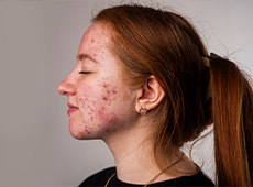 photodynamic-therapy