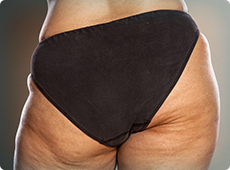 woman-with-cellulite-ben-001
