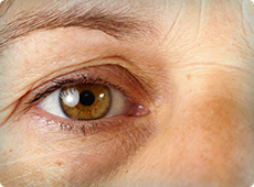 woman-with-eye-wrinkles-ben-002