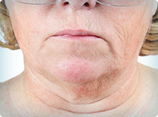 woman-with-saggy-neck-ben-001