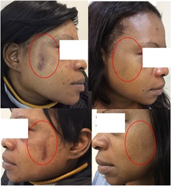 Improved post-inflammatory hyperpigmentation in patients with darker skin