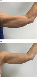 upper-arm-before-and-after